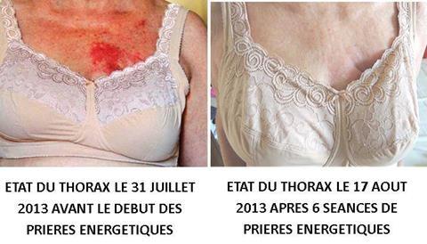 Action apres soins sur radiotherapie