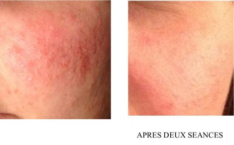 Avant et apres deux seances 2