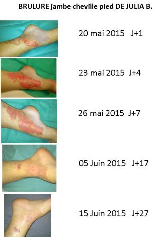 Brulure julia evolution 27 jours