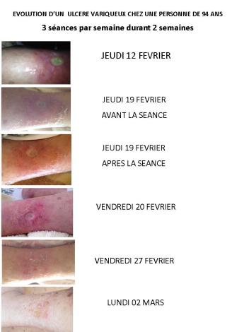 Evolution ulcere variqueux madeleine biot
