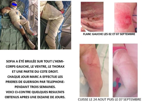 Radiotherapie Effets Indesirables